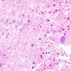 2B3 Toxoplasmosis (Case 2) H&E 1A