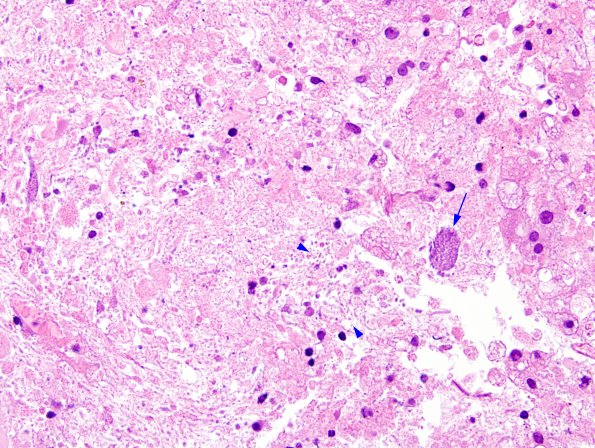 2B3 Toxoplasmosis (Case 2) H&E 1A