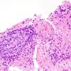 2B4 Toxoplasmosis (Case 2) H&E 5A