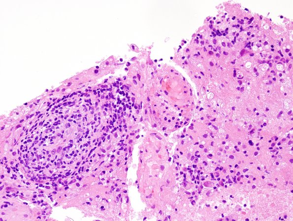 2B4 Toxoplasmosis (Case 2) H&E 5A