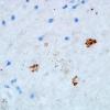 2C Toxoplasmosis (Case 2) anti-Toxo 100X 1