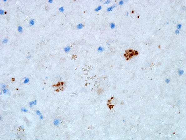 2C Toxoplasmosis (Case 2) anti-Toxo 100X 1