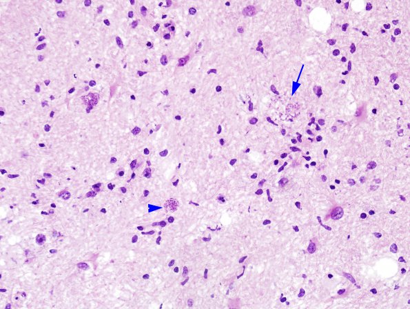 3A1 Toxoplasmosis (Case 3) H&E  3A