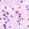 3A2 Toxoplasmosis (Case 3) H&E  1A