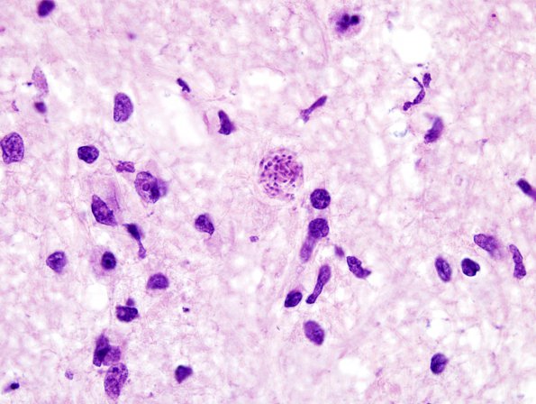 3A2 Toxoplasmosis (Case 3) H&E  1A