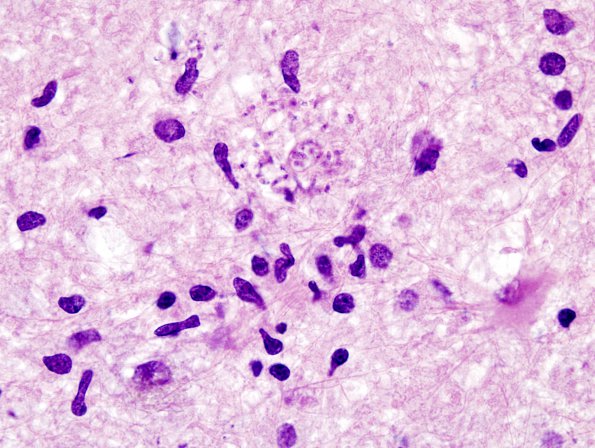 3A3 Toxoplasmosis (Case 3) H&E  2