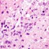 3A4 Toxoplasmosis (Case 3) H&E 3