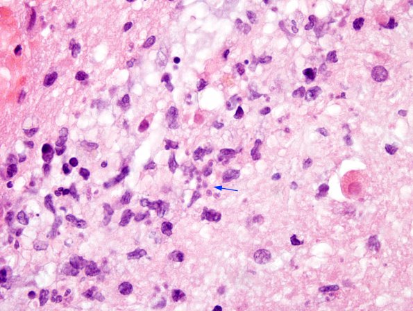 3A4 Toxoplasmosis (Case 3) H&E 3