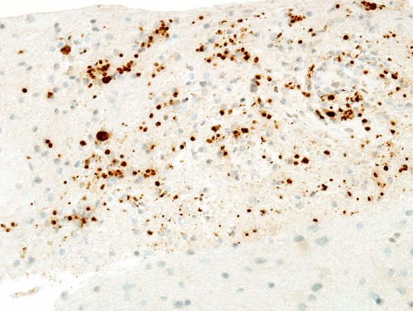 3C1 Toxoplasmosis (Case 3) Toxo IHC 4A