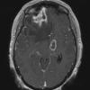 4A1 Toxoplasmosis, AIDS (Case 4) T1 W 1 - Copy