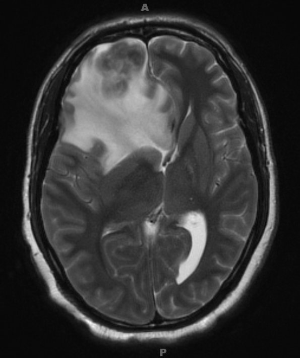 4A2 Toxoplasmosis, AIDS (Case 4) T2 W 2 - Copy