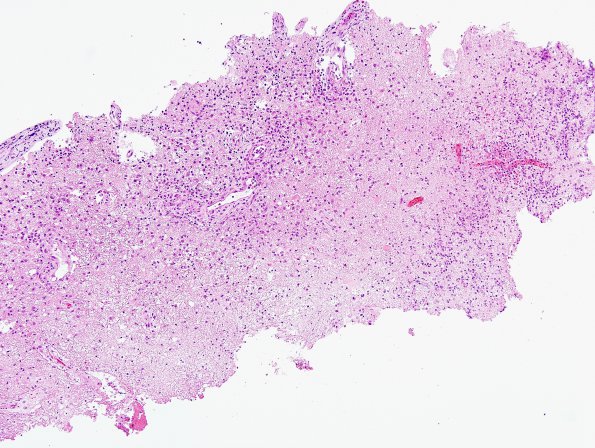 4B1 Toxoplasmosis, AIDS (Case 4) H&E 1