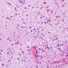 4B2 Toxoplasmosis, AIDS (Case 4) H&E 4