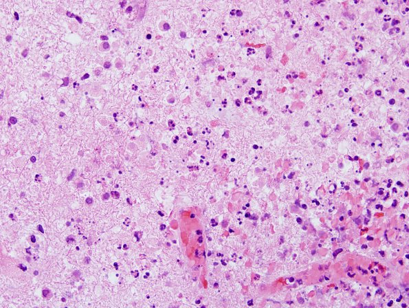 4B2 Toxoplasmosis, AIDS (Case 4) H&E 4