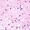 4B3 Toxoplasmosis, AIDS (Case 4) H&E 100X 3A