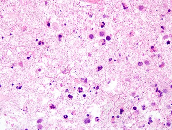 4B3 Toxoplasmosis, AIDS (Case 4) H&E 100X 3A