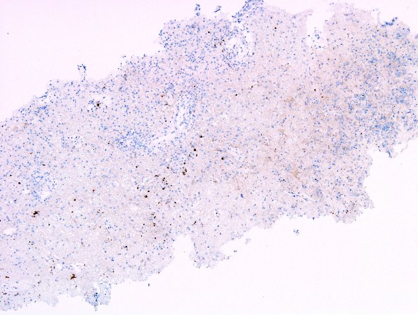 4C1 Toxoplasmosis, AIDS (Case 4) Toxo IHC 2 A