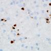 4C2 Toxoplasmosis, AIDS (Case 4) Toxo IHC 100X 2