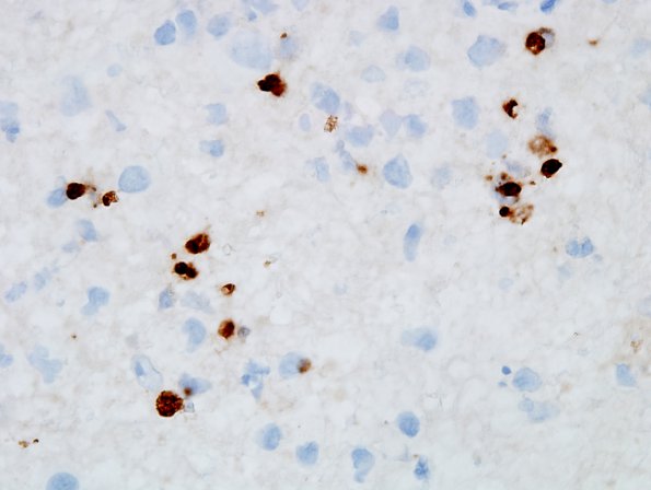 4C2 Toxoplasmosis, AIDS (Case 4) Toxo IHC 100X 2