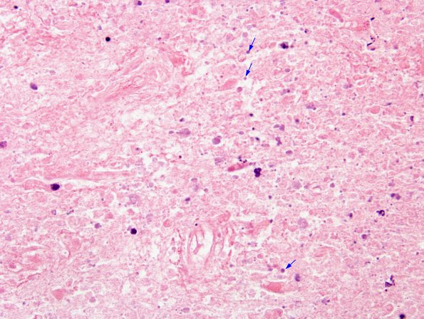 5A3 Toxoplasmosis (Case 5A) Tachyzoites H&E 1A