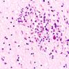 7A1 Toxoplasmosis (Case 7) H&E 40X 2A