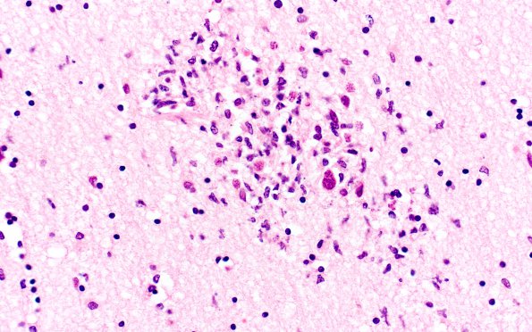 7A1 Toxoplasmosis (Case 7) H&E 40X 2A