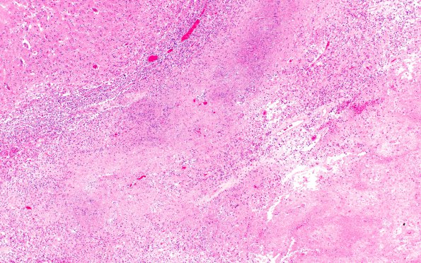 8B1 Toxoplasmosis (Case 8) & HIV 4X 1