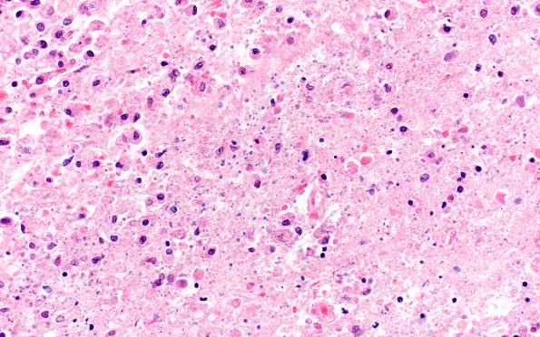 8B2 Toxoplasmosis (Case 8) & HIV 40X 2A