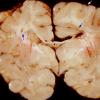 9A Toxoplasmosis (Case 9) gross 1