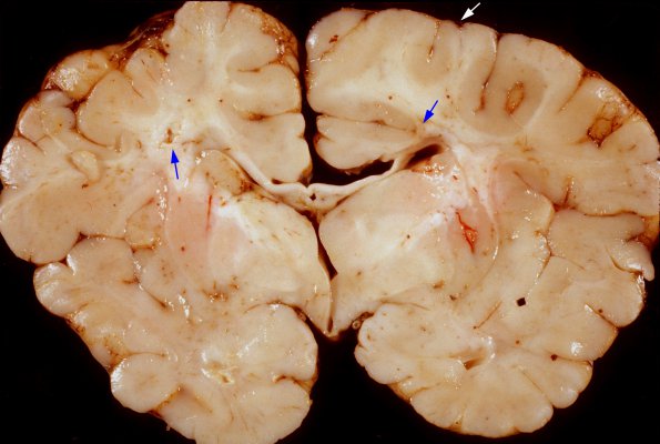 9A Toxoplasmosis (Case 9) gross 1