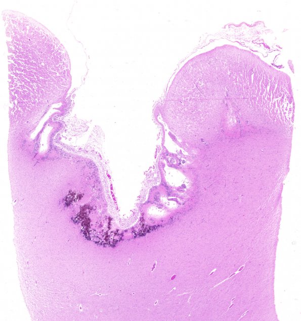 9B Toxoplasmosis, congenital (Case 9) H&E whole mount