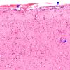 1A1 Adenovirus Encephalitis (Case 1) 13 copy