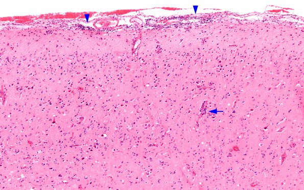 1A1 Adenovirus Encephalitis (Case 1) 13 copy