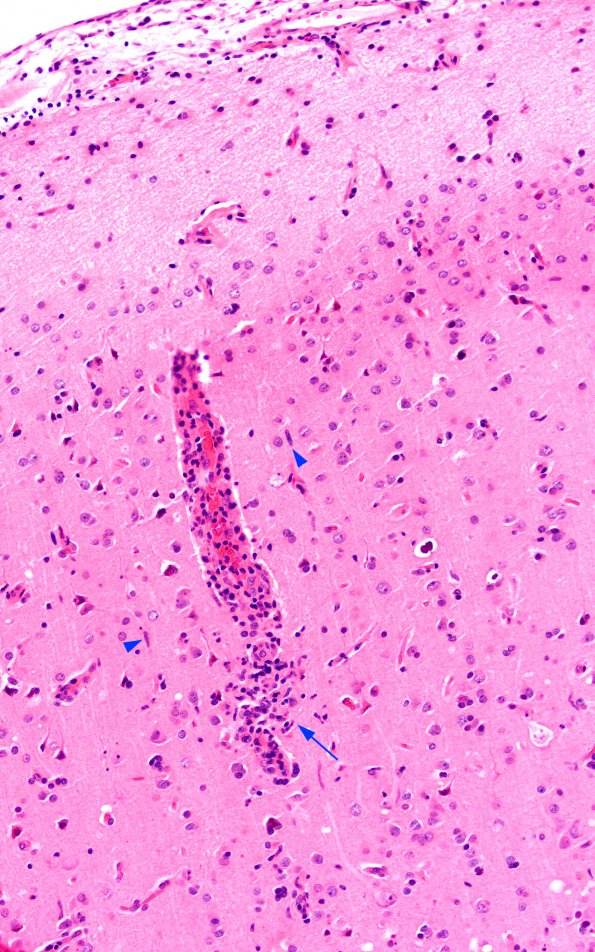 1A2 Adenovirus Encephalitis (Case 1) 6 copy