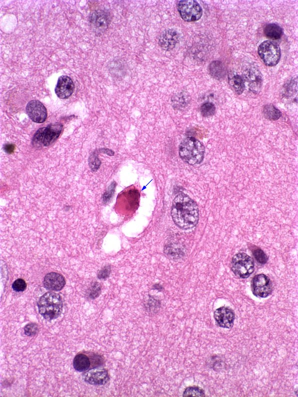 1A4 Adenovirus Encephalitis (Case 1) 14 copy