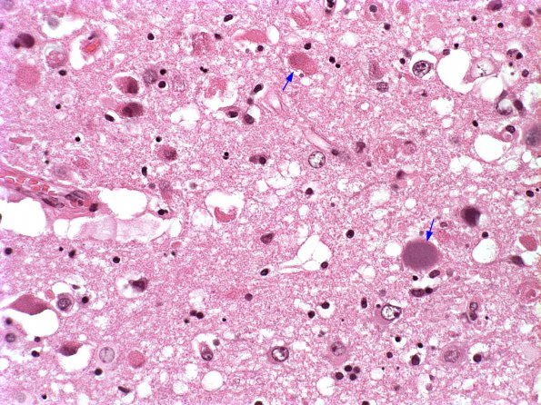 1A5 Adenovirus Encephalitis (Case 1) 7 copy