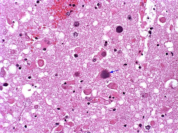 1A6 Adenovirus Encephalitis (Case 1) 10 copy