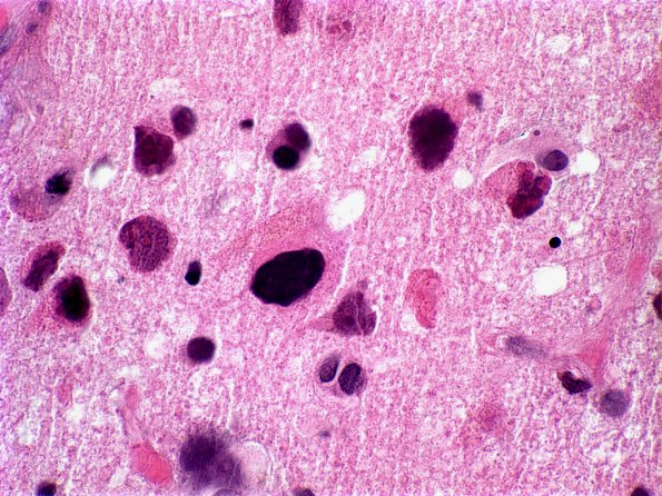 1A7 Adenovirus Encephalitis (Case 1) 11