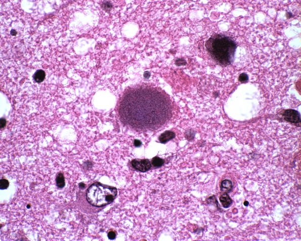 1A8 Adenovirus Encephalitis (Case 1) 5