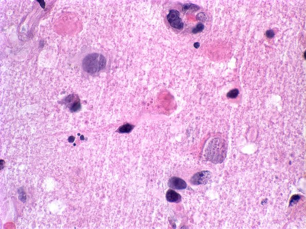 1A9 Adenovirus Encephalitis (Case 1) 15