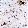 1B2 Adenovirus Encephalitis (Case 1) AdenoV IHC 1 copy