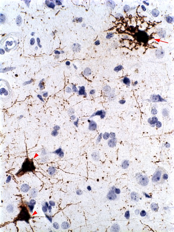 1B2 Adenovirus Encephalitis (Case 1) AdenoV IHC 1 copy