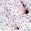 1B3 Adenovirus Encephalitis (Case 1) Adenov IHC 3