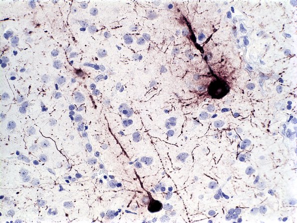 1B3 Adenovirus Encephalitis (Case 1) Adenov IHC 3