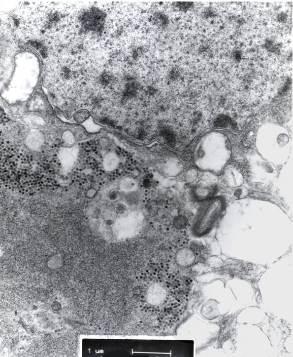 1C1 Adenovirus Encephalitis (Case 1) EM 5