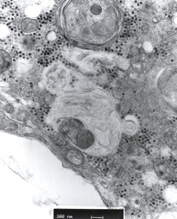 1C2 Adenovirus Encephalitis (Case 1) EM 3