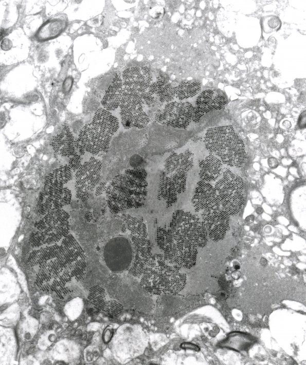 1C3 Adenovirus Encephalitis (Case 1) EM 2