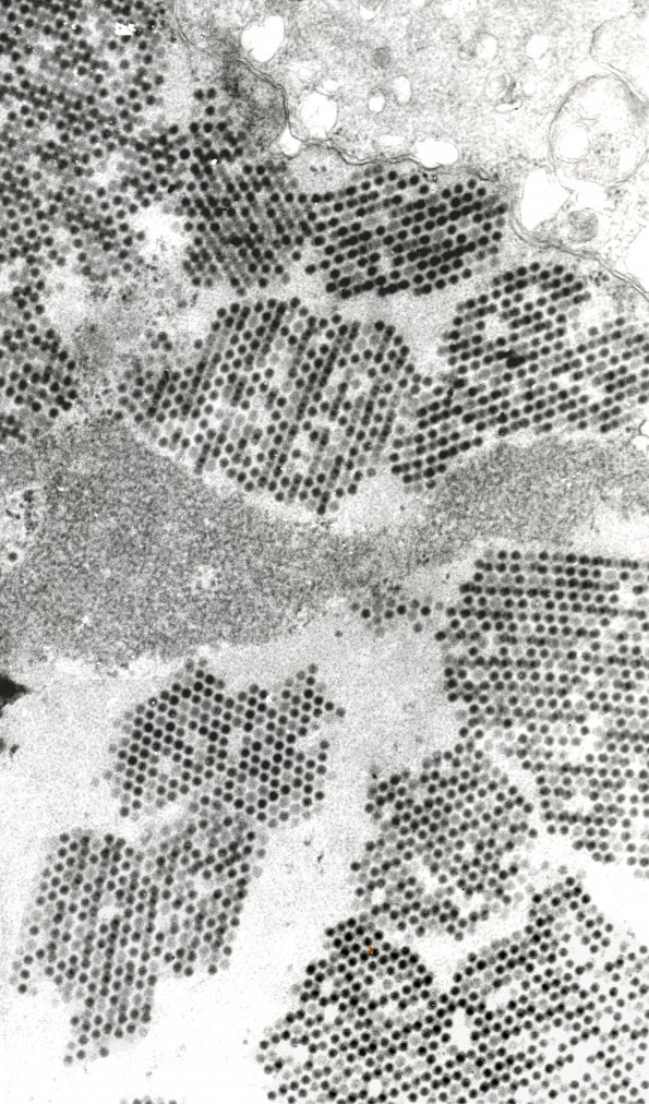 1C4 Adenovirus Encephalitis (Case 1) EM1