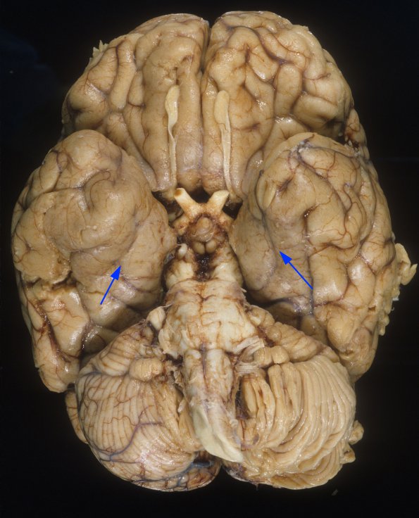 1E1 Adenovirus Encephalitis (Case 1) A17 copy