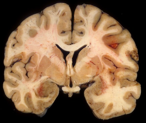 1E2 Adenovirus Encephalitis (Case 1) A3A